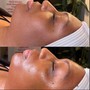 Microneedling