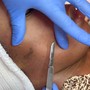 Dermaplaning