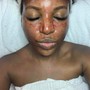 Acne Facial