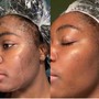 Microdermabrasion Facial