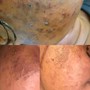 MicroNeedling