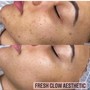 Face Reality Clarifying Acne Facial