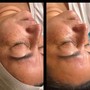 Dermaplaning Facial