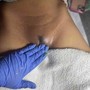 Butt Enhancment Vaccum therapy /Cupping