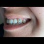 Teeth Whitening