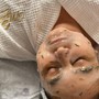 Microdermabrasion