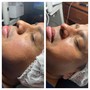 Facial