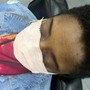 Scalp Treatment