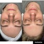 HydraFacial- Back Facial