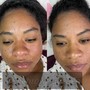 Acne Facial