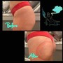 Love Handles (Side + Back Treatment)