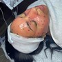 Dermaplane Facial