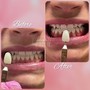 30 Minute Teeth Whitening