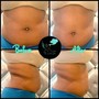 Love Handles (Side + Back Treatment)