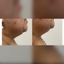 Neck and Chest firming treatment