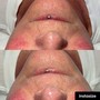 HydraFacial- Back Facial