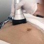 Radio Frequency Cellulite Removal