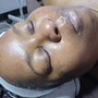 Acne Facial