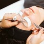 Microdermabrasion