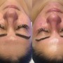 Anti-aging Ultrasonic Facial