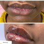 Needle less Lip filler