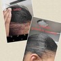 Scalp Treatment