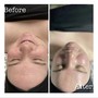 Underarm Facial