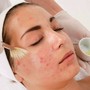 Acne Facial