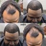 Hydrotherapy bald treatment w/ beard color