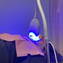 30 Minute Teeth Whitening