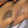 Partial Stomach Sugaring