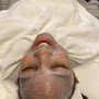 Microdermabrasion