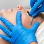 Microdermabrasion