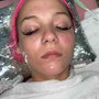 Acne Facial