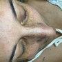 Dermaplaning Facial