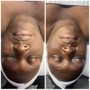 Dermaplane facial