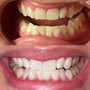 Teeth Whitening (60min)