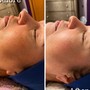 Acne Facial