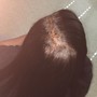 Scalp Treatment