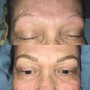 Lactic peel