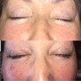 Diamond Dermabrasion