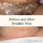 The Acne Killer Facial