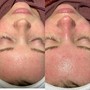 HydraFacial- Back Facial