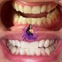 Teeth Whitening (60min)