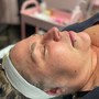 Microdermabrasion