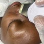 Hyperpigmentation Treatments