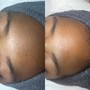 Microdermabrasion