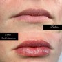 Lips- 1 mL Filler