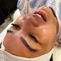 Microdermabrasion