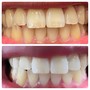 Teeth Whitening (30 Minute Session)